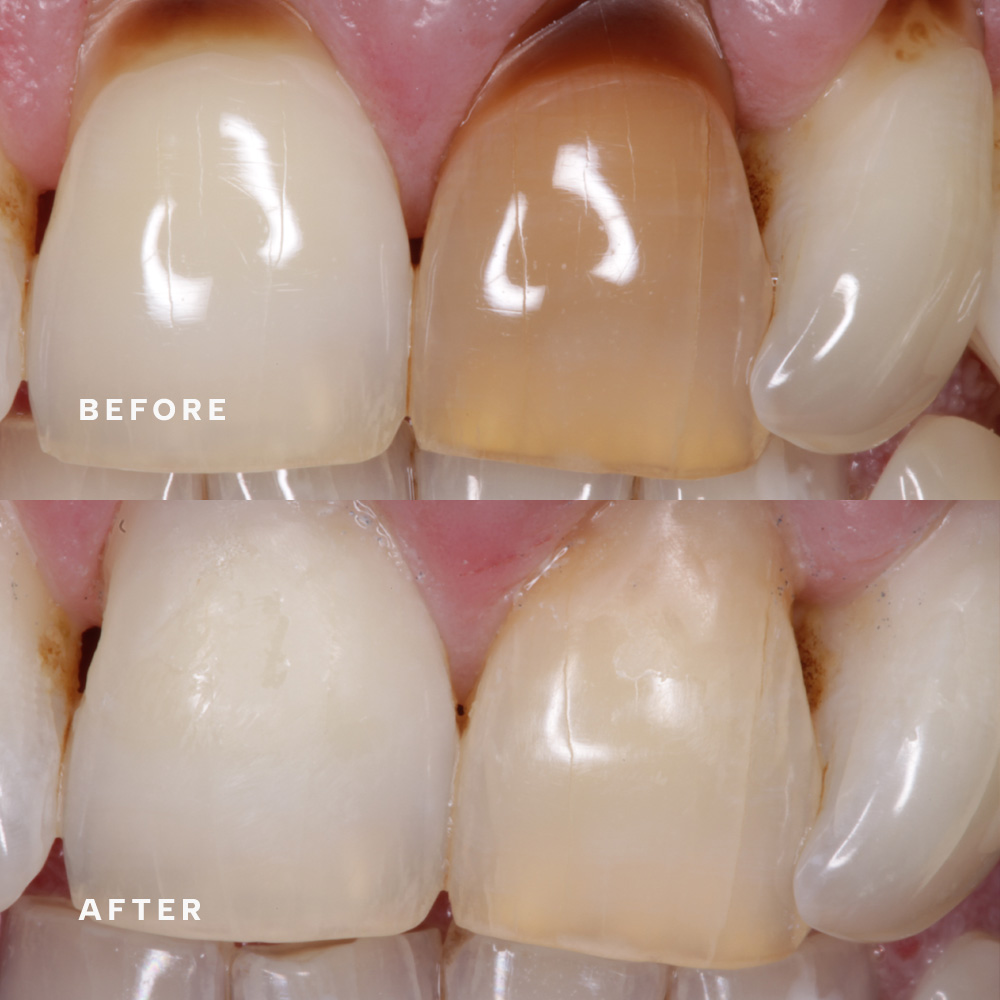 Before and after: darker front tooth colour-matched