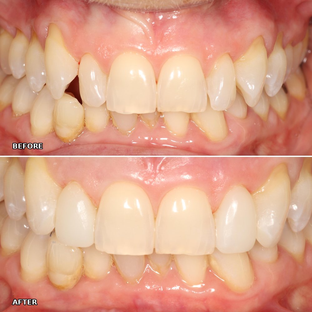 Before and after composite bonding: a gap closed and narrow side teeth built up
