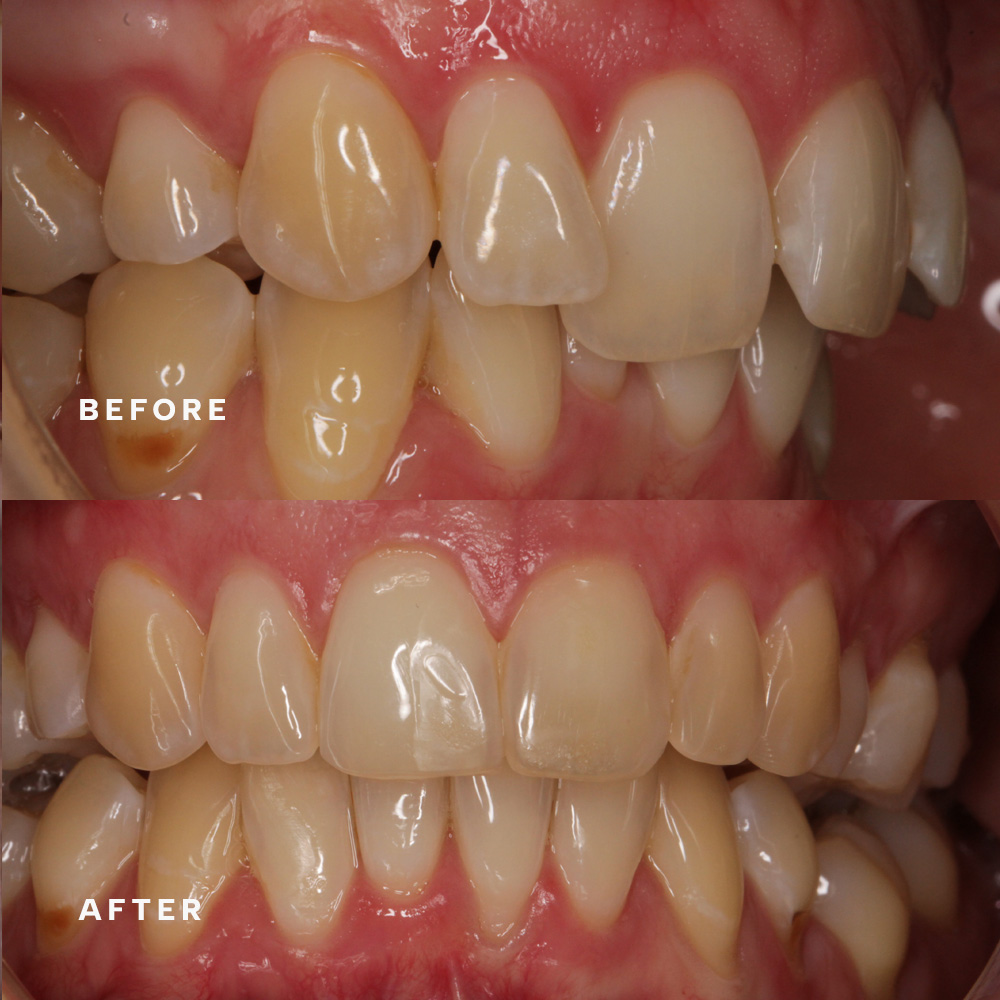 Before and after: uneven front teeth reshaped
