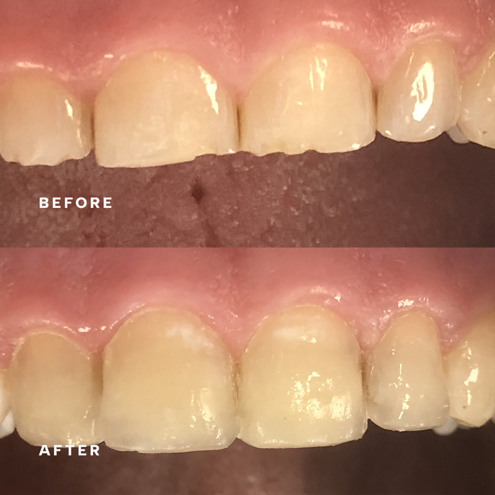 Before and after: worn front edges rebuilt